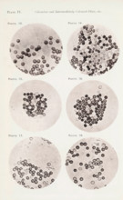 Six enlargements of blood cells, page, photomechanical print, number: 'Photo. 13., Photo. 18.',