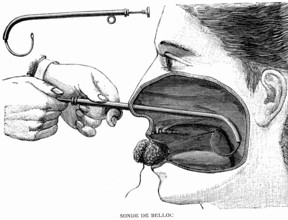 Belloc probe, cannula.Buffering of the nasal cavity
1887  ( Weekly journal by Dr. Gerard in Paris