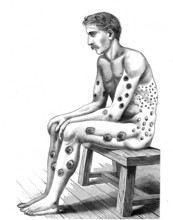 Man with syphilis. Weekly french magazine " Medecine illustree " by Dr. Gerard. November 1887