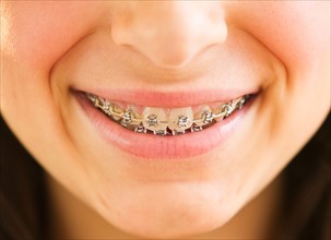 Close-up of girl's (12-13) teeth braces. Photo : Daniel Grill