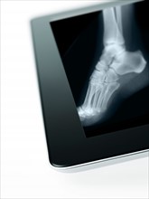 Studio shot of digital tablet with x-ray of human foot. Photo : David Arky