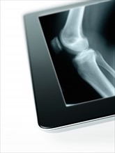 Studio shot of digital tablet with x-ray of human knee. Photo : David Arky