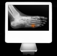 Broken toe appearing on diagnostic monitor. 
Photo: Calysta Images