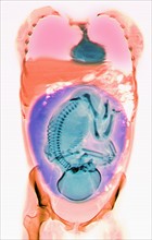 CT scan of abdomen of 25 year old pregnant woman with full term fetus. 
Photo : Calysta Images