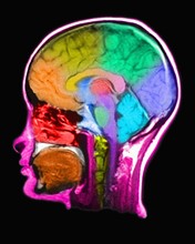 MRI Scan of human head. 
Photo : Calysta Images
