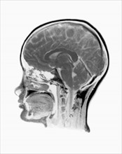 MRI Scan of human head. 
Photo : Calysta Images