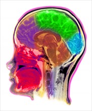 MRI Scan of human head. 
Photo: Calysta Images