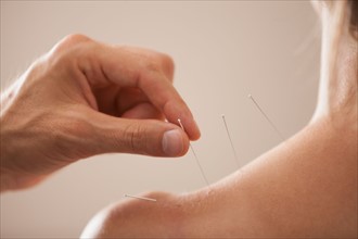 Doctor's hand putting in acupuncture needle. Photo : Mike Kemp