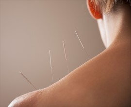 Close-up of Acupuncture needles in back. Photo: Mike Kemp