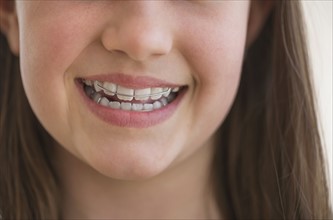 girl (10-11) wearing dental braces smiling.