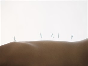 Close up of woman with acupuncture needles in back