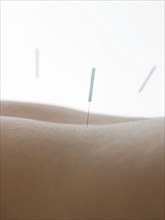 Close up of acupuncture needles in back of woman