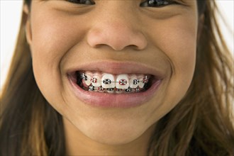 Asian girl smiling with braces
