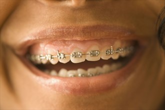 Close up of African woman with orthodontic braces