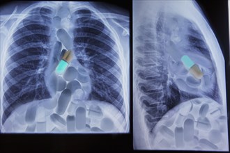 Close up of x-rays of pharmaceutical pills in chest