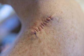 Medical stitches in woman's back after surgery