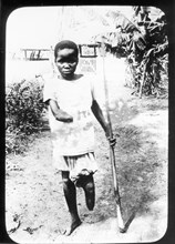 Congo Free State mutilations. Portrait of a mutilated boy whose hand and foot have been amputated: