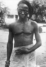 Congo Free State mutilations. Portrait of a young Congolese man identified as 'Lomboto of