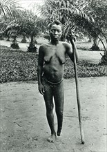 Congo Free State mutilations. Portrait of a mutilated woman whose foot has been amputated: a victim
