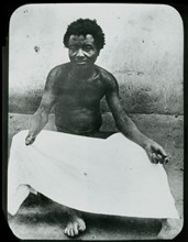 Congo Free State mutilations. Portrait of a mutilated man whose hand has been amputated: a victim
