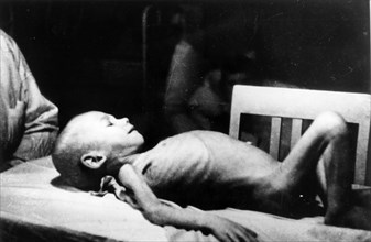 A dystrophic child examined in the leningrad pediatrics institute during world war ll.
