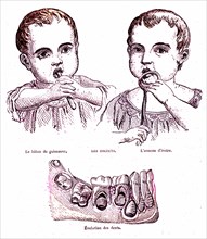 Evolution of the child teeth, ' life and health' book by dr jules rengade. paris 1881