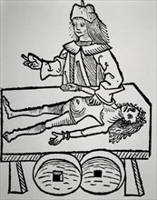 Operation a calculation of the gallbladder. Xilografia. Hortus Sanitatis by Johannes de Cuba (1430-1503). 15th C.