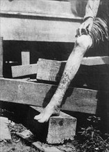Man showing his leg with hook worm disese ca.  between 1910 and 1935