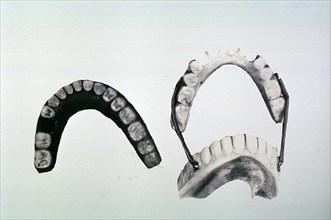 Ceylonese dentures