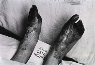 Photograph of two cadaverous feet