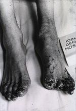 Photograph of two cadaverous feet