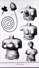 Tumors in the breast ca. 1700s