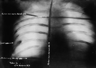 Theodore Roosevelt's chest x-ray after John F. Schrank's attempted assassination of U.S. President Teddy Roosevelt in Oct. 1912