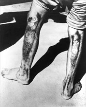 Effects of Atomic Heat and Radiation on Humans, Japan ca. 1945