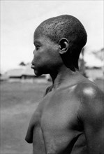 afrique, congo belge, le seul spécimen de lupus trouvé lors de l'expédition chez les pygmées, 1927 1930