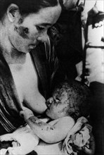 Mother And Son After The Atomic Explosion In Nagasaki.