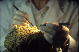 Dissection of a human brain, brain research, 2004