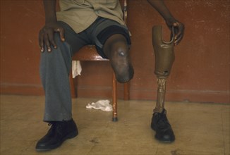 MOZAMBIQUE, Maputo, Mine victim holding prosthetic limb.Central Hospital