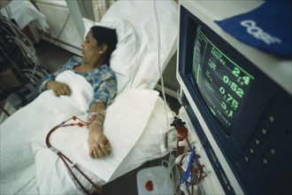 HEALTH, Kidney Dialysis, Woman lying in a bed with tubes running from her arm and monitor in the