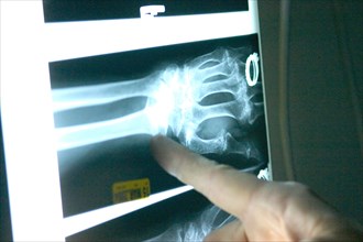 USA, Minnesota, Plymouth, Emergency room doctor pointing at x-ray of broken wrist of 90 year old