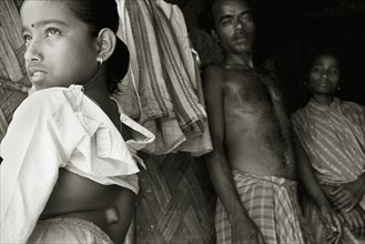 INDIA, West Bengal, Mal, Parents display a growth on their daughter's spine in a West Bengal