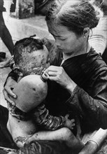VIETNAM, South, Cam Che, Badly burned Vietnamese baby caught in bursting napalm bomb between US