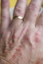 WEST INDIES, Grenada, St Georges, Hand of a white caucasian man with mosquito bites.