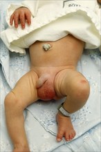 Children, Babies, New Born, Five day old baby with swollen enlarged gentials and umbical stump
