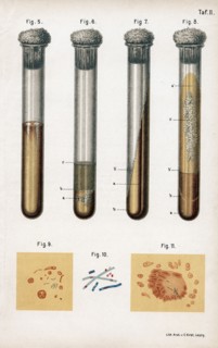 5:Pneumonia culture