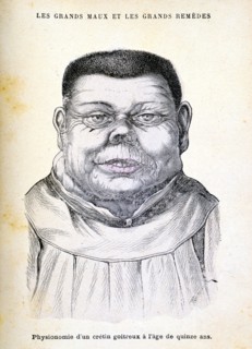 Cretin aged 15