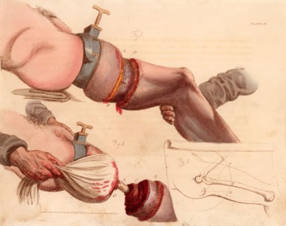 Amputation of the leg at the thigh