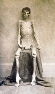 A Federal prisoner, returned from prison American Civil War c 1865