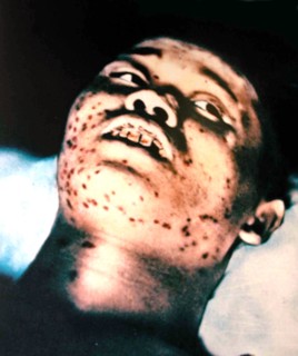 Victim of the Hiroshima Nuclear explosion