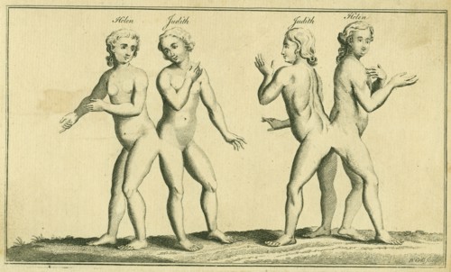 Siamese or conjoined twins